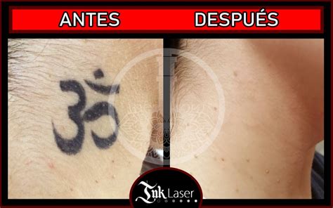 Tatuajes Borrados Con L Ser Antes Y Despu S Resultados Reales