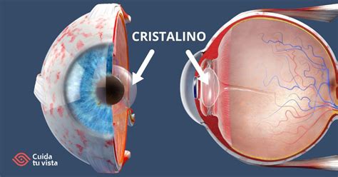 El Cristalino La Primera Estructura Del Ojo En Mostrar Signos De Porn