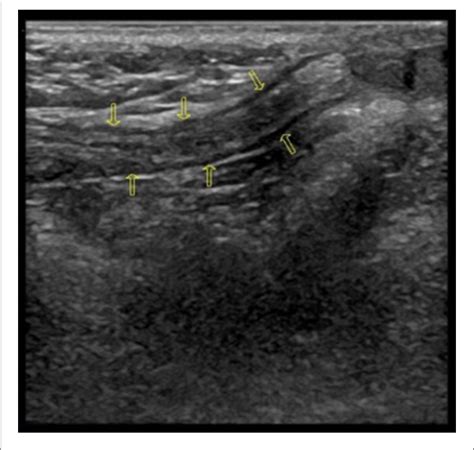 Figure 1 From Pre Operative Spermatic Cord Ultrasonography Helps To