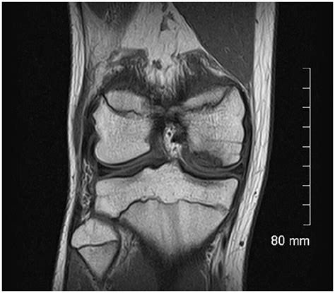 Osteochondritis Dissecans Of The Knee Imaging Instability Concept