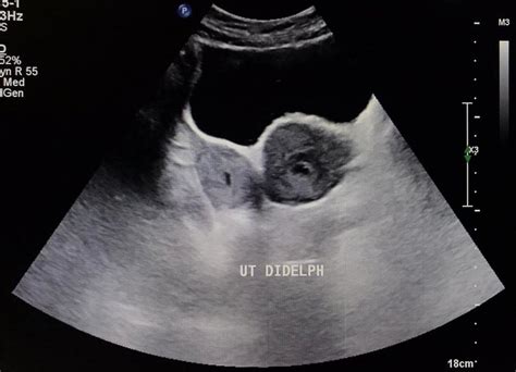 Didelphys Uterus Ultrasound