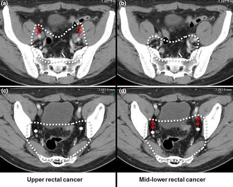 Example Of Lateral Pelvic Lymph Node Lpln Target Volume Delineation Download Scientific