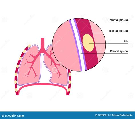 Pleurisy Is Pleura That Separate Lungs From Chest Wall And It Becomes