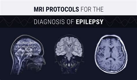 MRI Protocols for Diagnosing Epilepsy | Medical Professionals