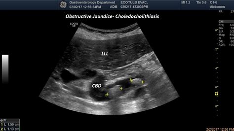 Obstructive Jaundice Choeledocholithiasis 02 1 Image Efsumb