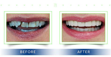 Crown and Bridge Before and After | Brunswick East Dental Studio VIC