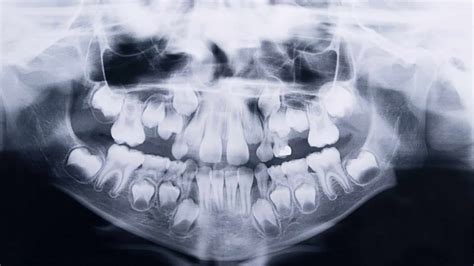 Radiologia Pruszk W Pantomogram Cefalometria Tomografia Cbct Annamed