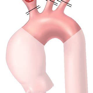 Various Techniques For Unilateral And Bilateral Antegrade Cerebral