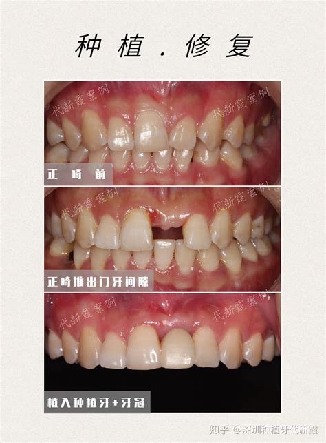 天生缺一颗门牙牙齿乱长还不齐有一颗磨牙因为得了蛀牙小时候被拔掉了这种情况该怎么办呢 知乎