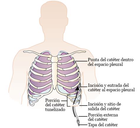 Información sobre su catéter PleurX Memorial Sloan Kettering Cancer