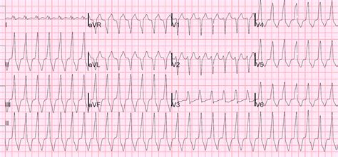 Dr Smith S ECG Blog Regular Wide Complex Tachycardia What Is The