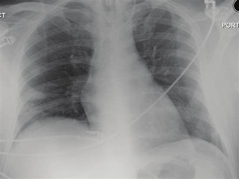 Allowing For The Rotation The Ap Chest Radiograph Post Decannulation