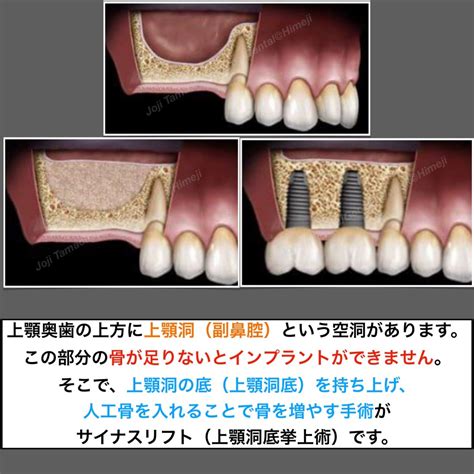 サイナスリフトとは？上顎洞底挙上術とは？