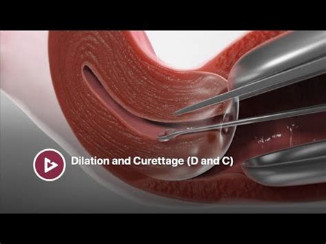 Dilation and Curettage (D&C) #3d #animation Procedure - YouTube