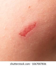 Wound On Human Skin Background Stock Photo Shutterstock