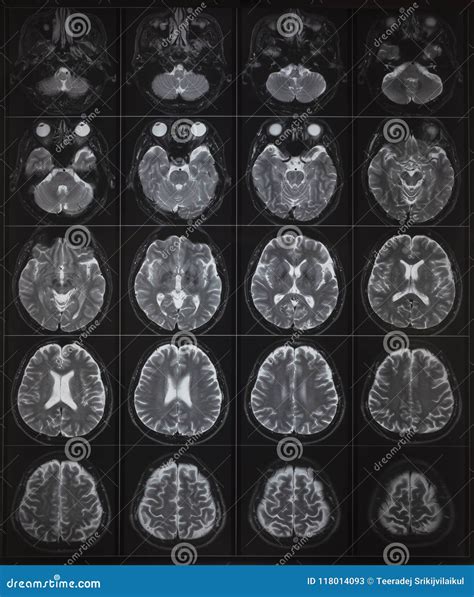 Human Brain Mri On Light Box Stock Image Image Of Medical Radiology