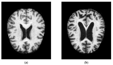 Ijerph Free Full Text Identification Of Alzheimers Disease By