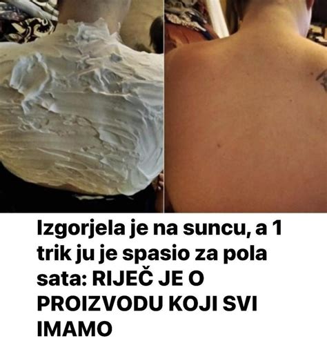 Izgorjela Je Na Suncu A Trik Ju Je Spasio Za Pola Sata Rije Je O