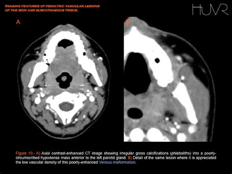 Figure 7 From Imaging Features Of Pediatric Vascular Malformations Of The Skin And Subcutaneous