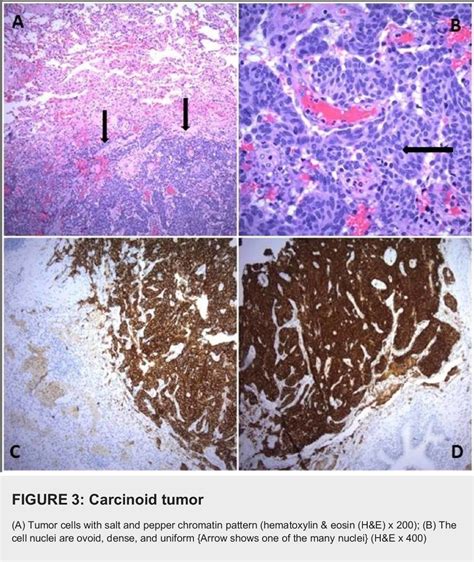 Figure From Multiple Bilateral Incidental Lung Nodules In A Patient