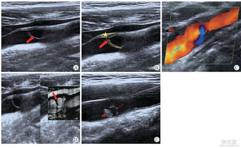 颈动脉蹼常规超声图像特点探究超声医学论文学术堂