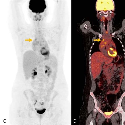 Fdg Pet Ct Mip Image A And Coronal Fdg Pet Ct Fusion Images B