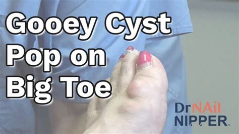 Gooey Cyst Pop On Big Toe Mucoid Cyst 2023 Dr Nail Nipper