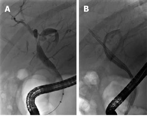 Anastomotic And Nonanastomotic Biliary Strictures In A Liver