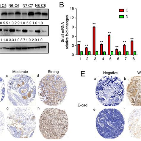 Snail And E Cad Expression In Colorectal Cancer A Ratio Of Grayscale Download Scientific