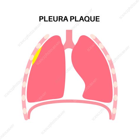 Pleural Plaque Illustration Stock Image F Science Photo