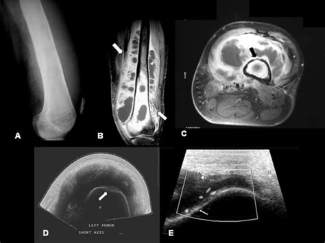 Radiographic Imaging In Osteomyelitis The Role Of Plain Radiography