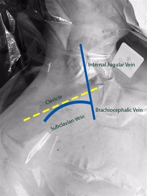 Tips And Tricks Us Guided Subclavian Vein Em Ultrasound Section