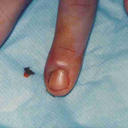 cellulitis finger - pictures, photos