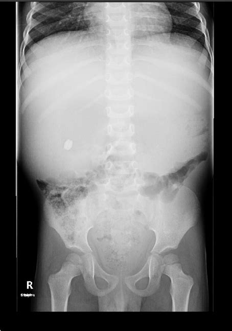 X Ray Abdomen That Shows Hugely Distended Stomach With A Radio Opaque Download Scientific