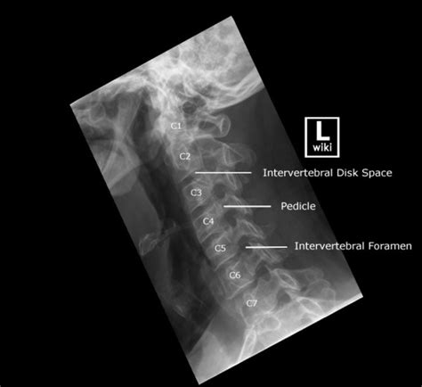 Cervical Spine Radiographic Anatomy Radiologypics Com