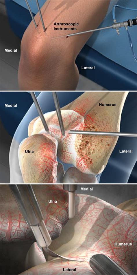 Debridement