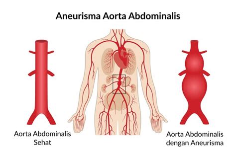 Waspadai Aneurisma Aorta Kenali Penyebab Gejala Penanganan Dan