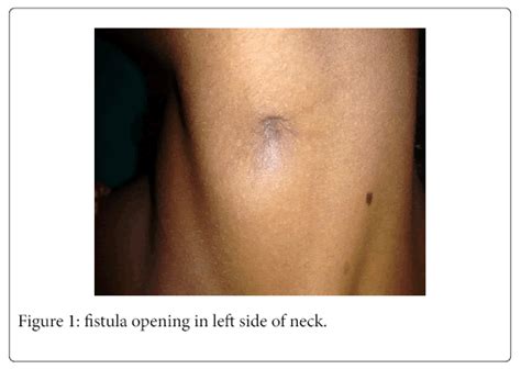 Thyroglossal Cyst And Fistula Surgical Pitfalls And Causes Of Images