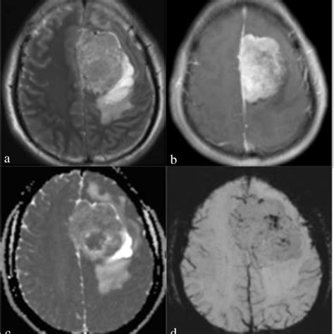 A Year Old Man With Angiomatous Meningioma A Axial T Weighted