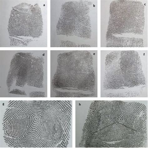 a An unusual fingerprint pattern named as a loop with an inverted loop ...