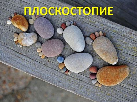 Плоскостопие - презентация онлайн