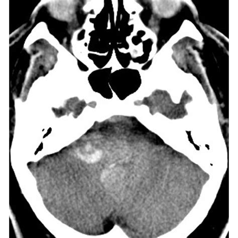 Axial A And Coronal B Noncontrast Computed Tomography Ct Of The