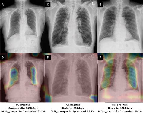 Deep Learning Prediction Of Survival In Patients With Chronic