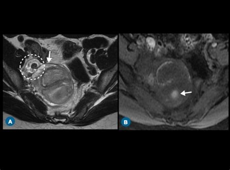 Axial MRI images demonstrate the enlargement of the right ovary with... | Download Scientific ...