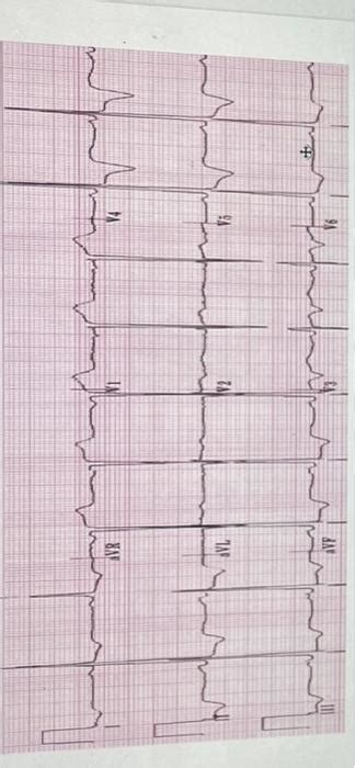 Solved interpret 12 lead ekg please | Chegg.com