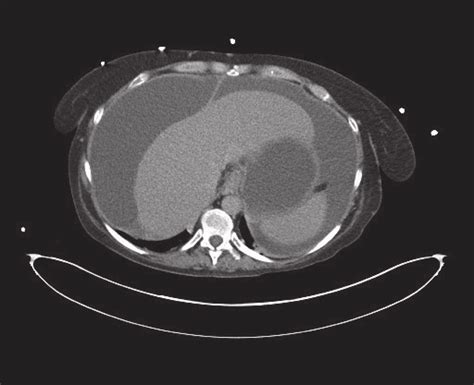 Ascites Ct Scan