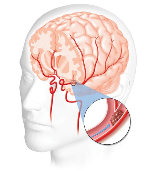 stroke symptoms cliparts   stroke symptoms cliparts
