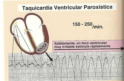 Dr Rafael Soto Cardiocito En Construcción Y Electrocardiograma Taquicardia Ventricular