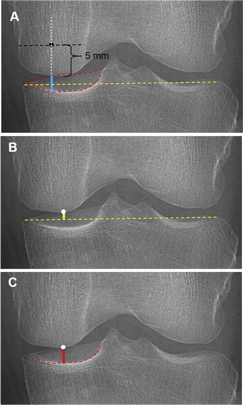 Characterization Of The Mid Coronal Plane Method For Measurement Of