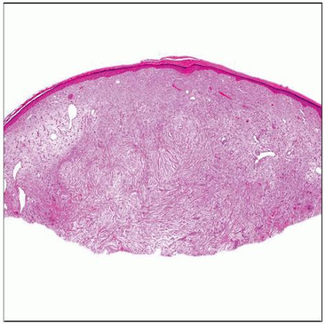 Sclerotic Fibroma Basicmedical Key